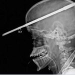 داستان واقعی: نجات معجزه آسای یک نوجوان